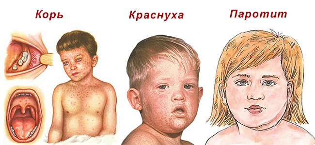 корь краснуха паротит