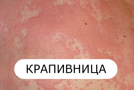 крапивница