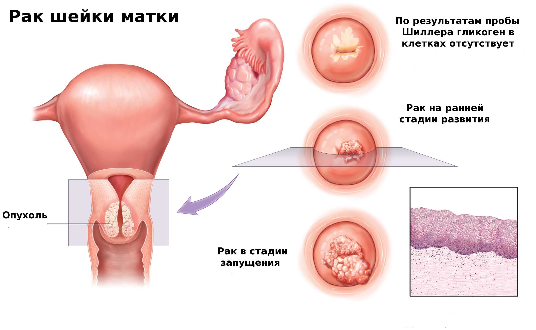 рак шейки матки